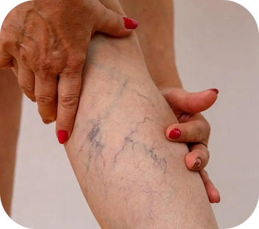 Spider Veins